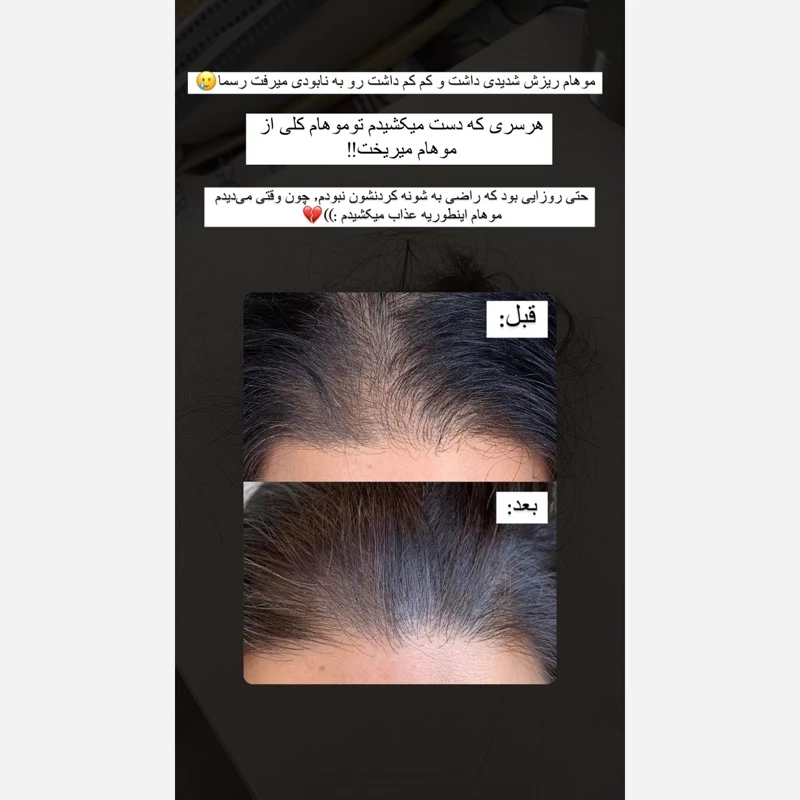 محلول رویش مجدد تقویت مو رشد موها پرتیین تقویتی ضد موخوره مخصوص همه موها و مو اسیب دیده محلول تقویت ریش